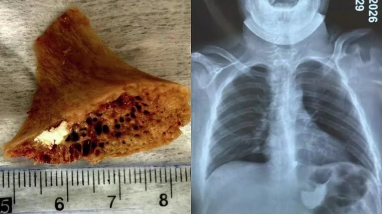 Бишкекте өспүрүмдүн кызыл өңгөчүнө сөөк тыгылып калып, операция аркылуу алынды